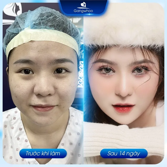 Gangwhoo - Địa chỉ bấm mí Hàn Quốc uy tín, chất lượng