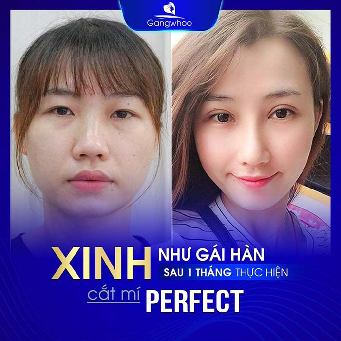 Cắt mí Perfect là giải pháp thẩm mỹ mắt tối ưu nhất hiện nay