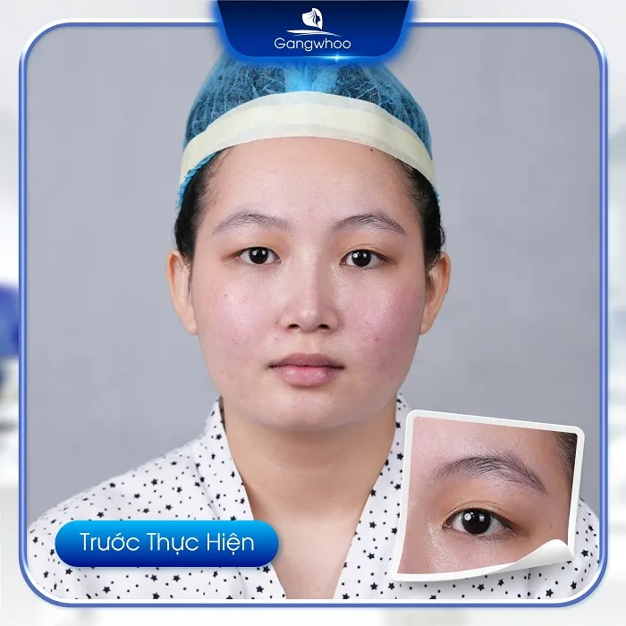 Đối tượng áp dụng cắt mí Perfect