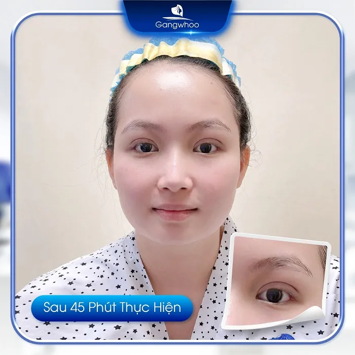 Cách chăm sóc sau khi thực hiện cắt mí Perfect