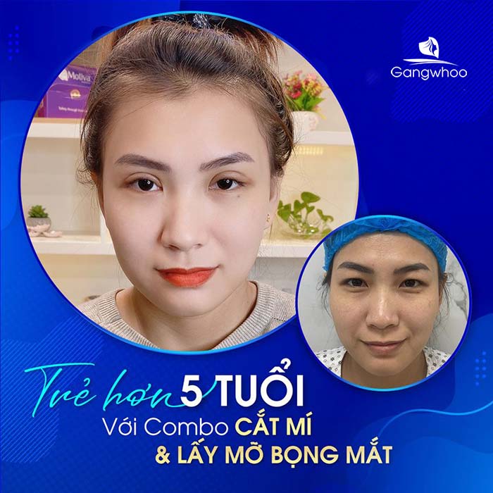 Cắt Mí - Lấy Mỡ Bọng Mắt - Combo Trẻ Hóa Toàn Diện