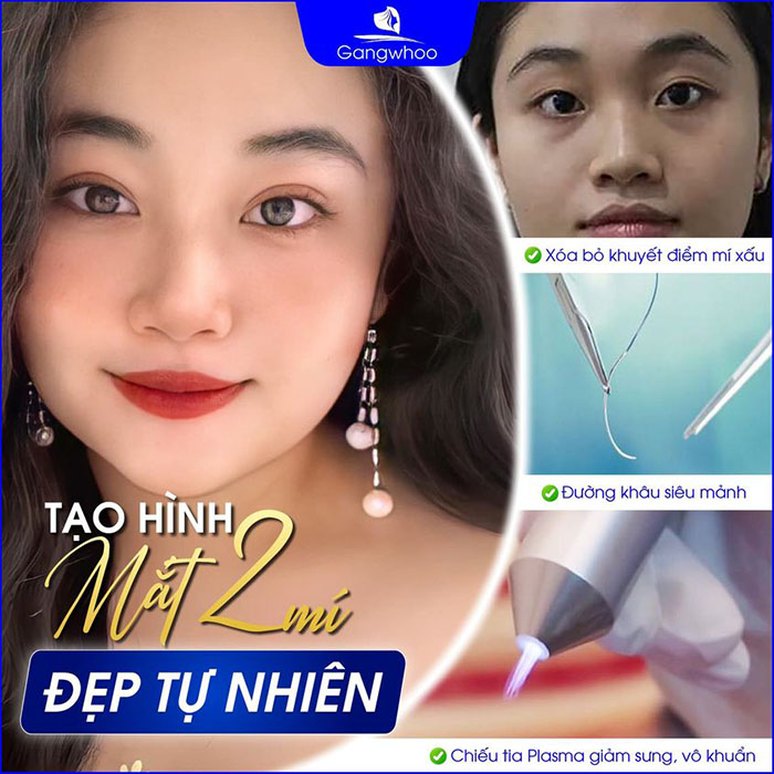 Bấm mí Dove Eyes dịch vụ thẩm mỹ mắt cực “hot” tại TMV Gangwhoo.