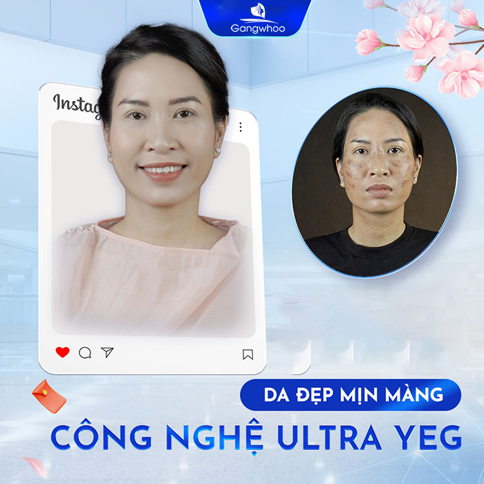 Sự thay đổi về nội tiết tố trong cơ thể dẫn đến nhiều vấn đề liên quan đến làn da, trong đó có cả tình trạng nám. 