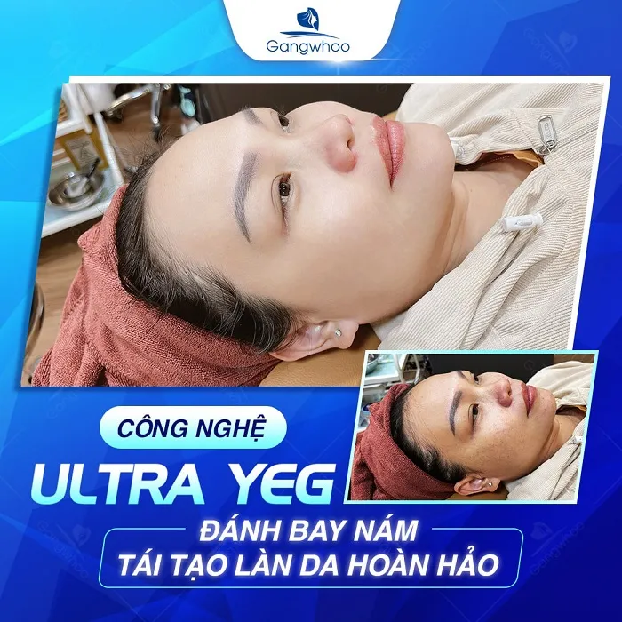 Thời gian trung bình cho một liệu trình trị nám thường từ 1 tháng đến 1 năm