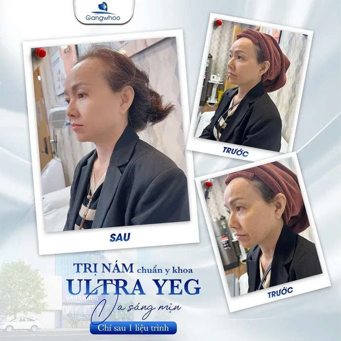 Điều Trị Nám Da Tận Gốc Bằng Công Nghệ Ultra YEG tại Gangwhoo