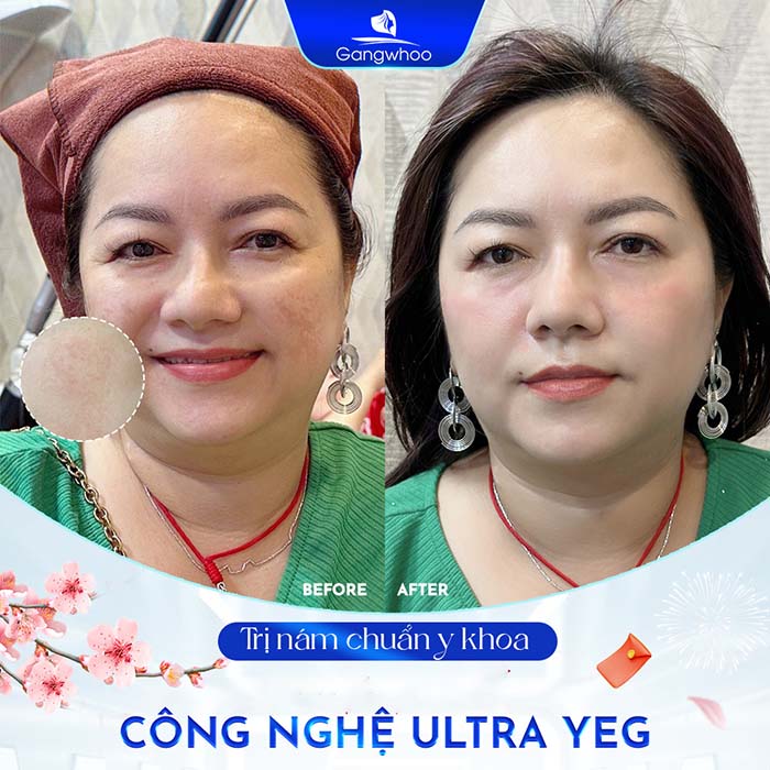 Công nghệ Ultra – Yeg không gây thương tổn, không bào mòn da