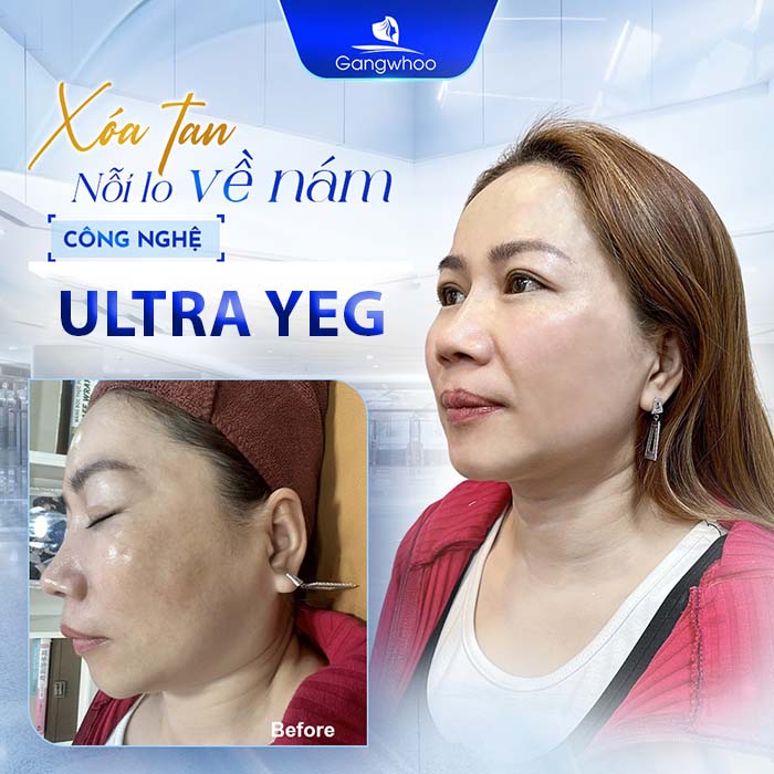 Công nghệ Ultra Yeg điều trị nám từ nhẹ đến nặng.