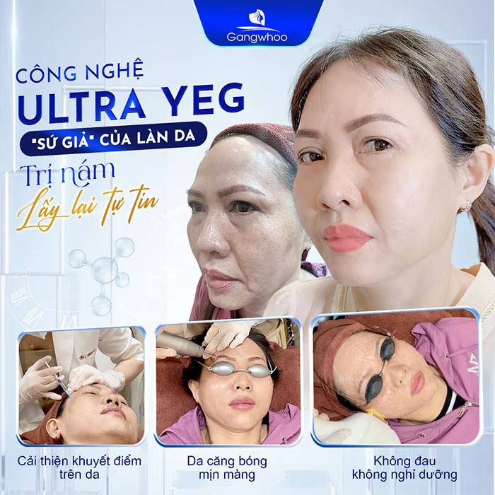 Công nghệ Ultra YEG - "Khắc tinh" của làn da nám, sạm