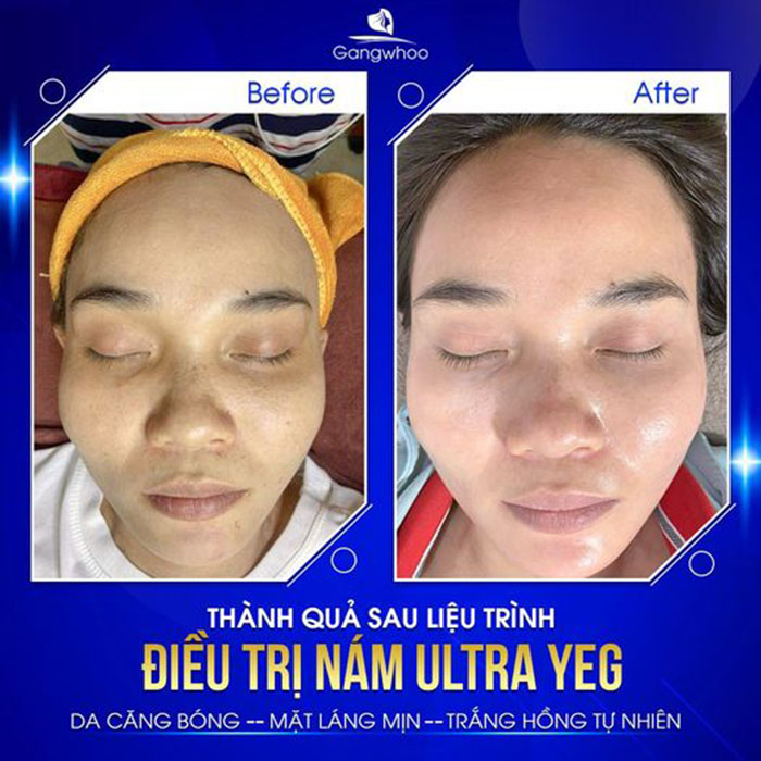 Da căng bóng - Mặt láng mịn với công nghệ điều trị nám Ultra YEG