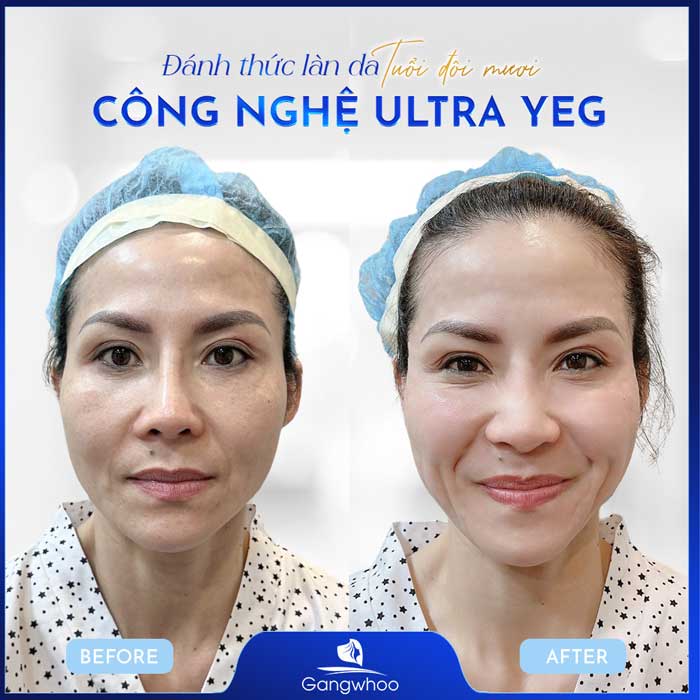 Điều Trị Nám Da Tận Gốc Bằng Công Nghệ Ultra YEG