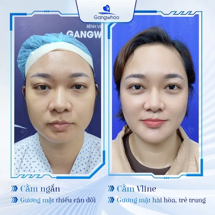 Giải quyết nỗi lo cằm ngắn với phương pháp độn cằm