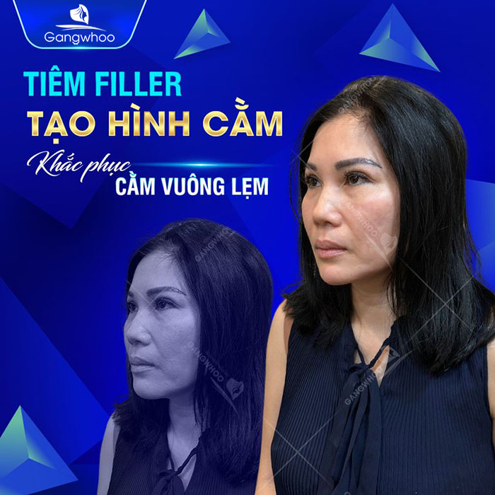 Tiêm filler là phương pháp thẩm mỹ không phẫu thuật