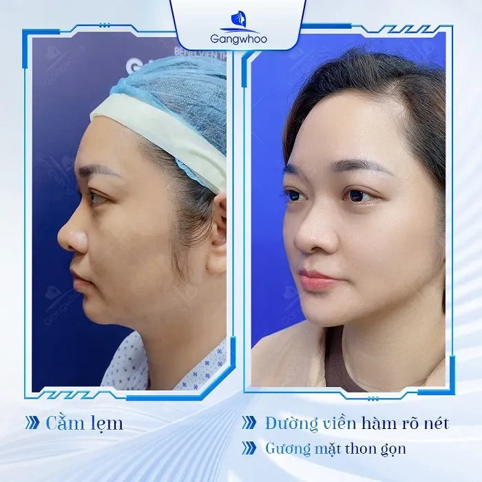 Dáng cằm thanh tú, thon gọn, V-Line đúng chuẩn