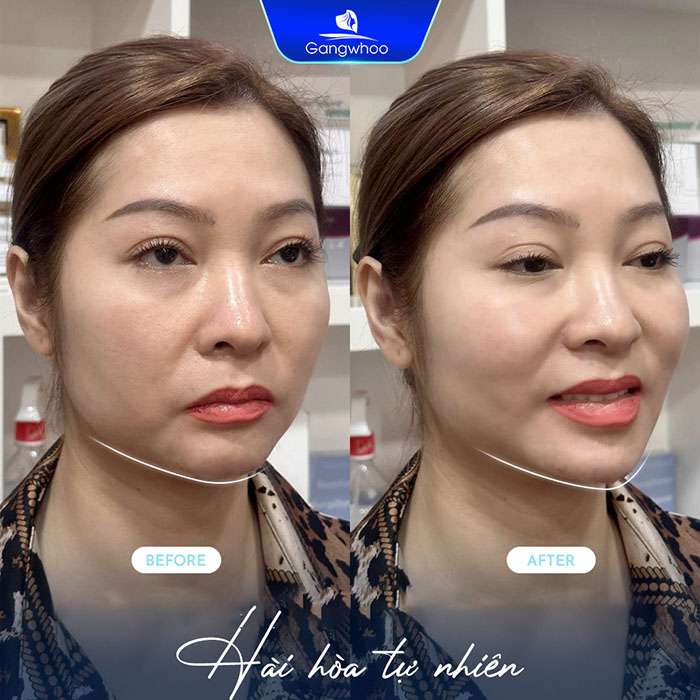 Độn cằm giúp tổng thể gương mặt cân đối hơn.