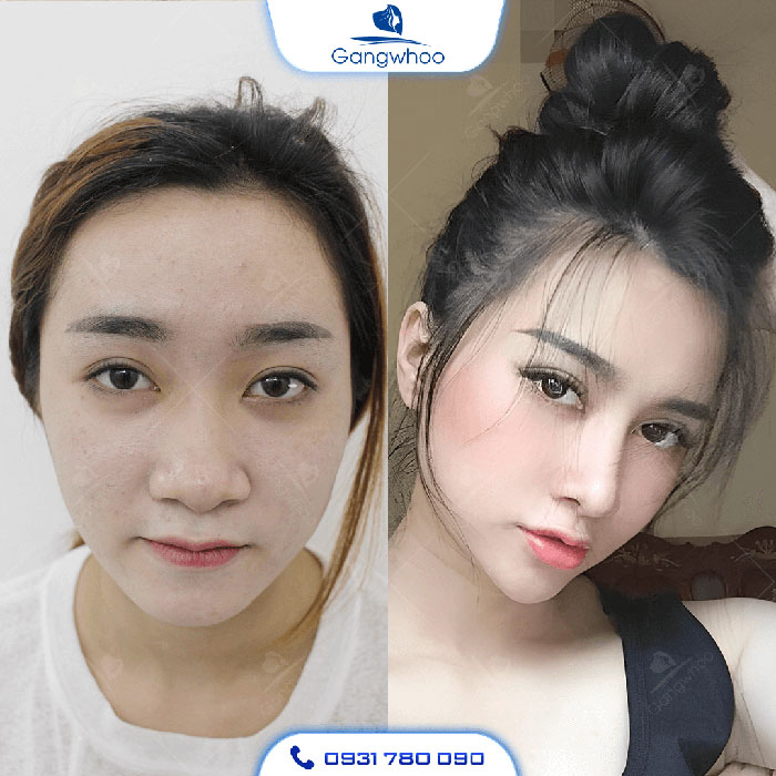 Khuôn mặt đẹp sắc sảo sau khi độn cằm