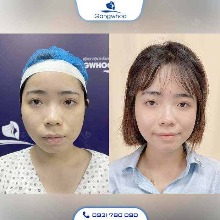 Cằm ngắn thường làm gương mặt trông có vẻ ngắn hơn thông thường