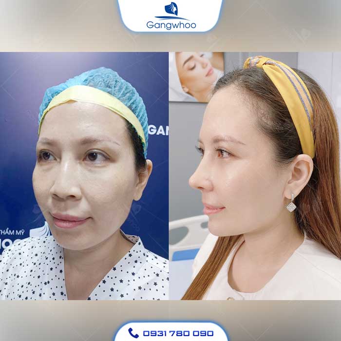 Cằm thụt về phía sau, thiếu độ nhô, gây ra hiện tượng cằm lẹm