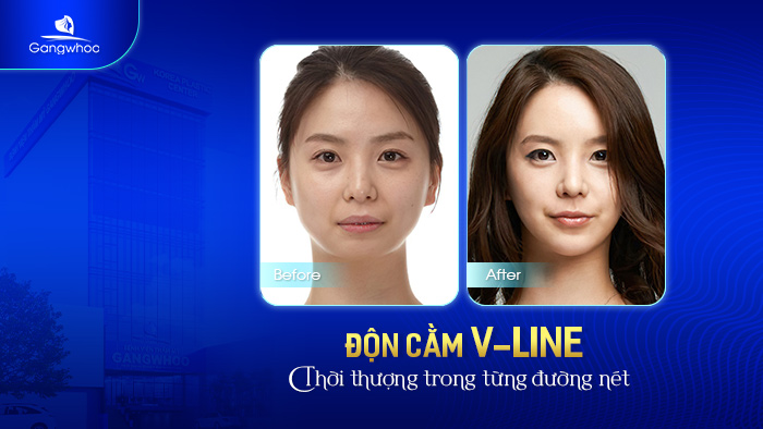 Độn cằm V-line tại TMV Gangwhoo đẹp không "góc chết"