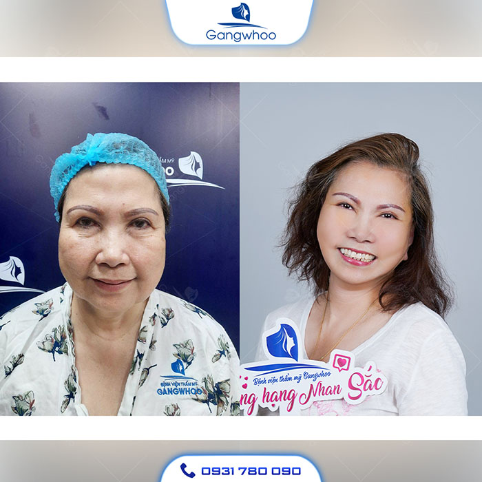 Đẹp rạng ngời sau khi độn rãnh mũi má tại TMV Gangwhoo