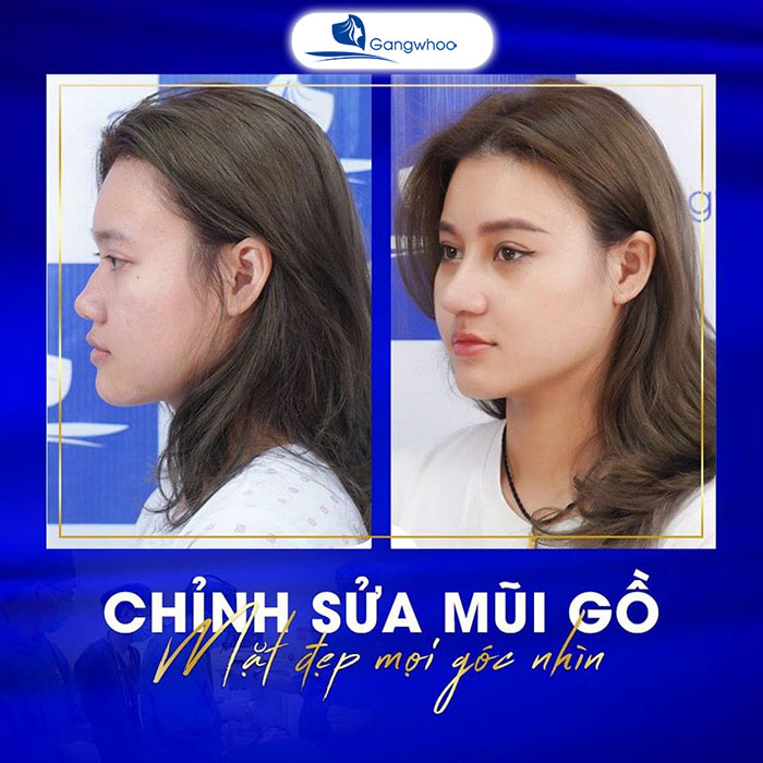 Mài gồ xương mũi - Mũi đẹp chuẩn "thần thái"