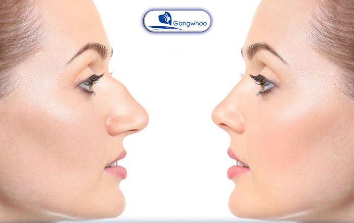 Mài gồ xương mũi giúp khắc phục được khuyết điểm mũi bị gồ hiệu quả