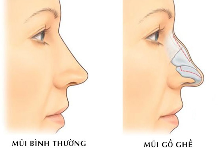 Sự khác nhau giữa mũi gồ và mũi bình thường