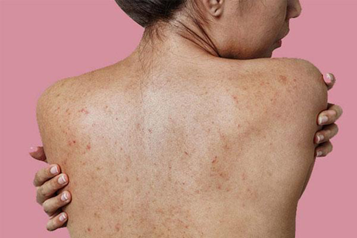 Làn da sạm đen khiến không ít chị em tự ti, mặc cảm