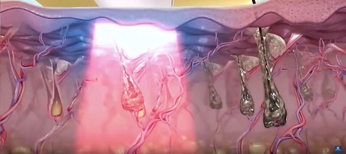 Triệt lông bằng công nghệ OTP Double Light kết hợp từ công nghệ IPL – RF hấp thụ melamin trong ống lông