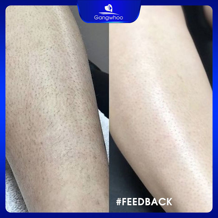 Triệt lông bằng công nghệ OTP Double Light trị dứt điểm tình trạng viêm nang lông