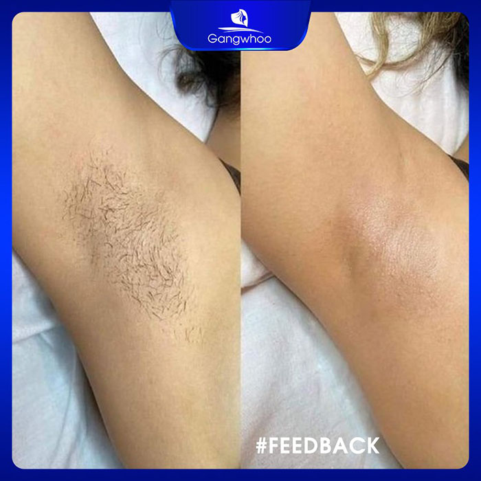 Lông sẽ thưa đi 80 đến 90% sau 1 lần điều trị