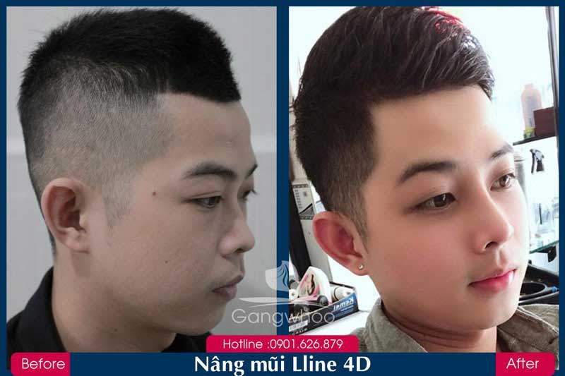 Khách Hàng Nâng Mũi S-Line 4D Gangwhoo