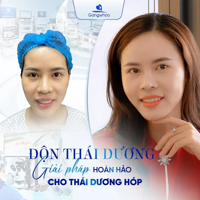 Độn thái dương là gì?