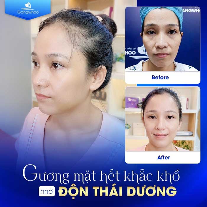 Vẻ đẹp trẻ trung sau 30 phút độn thái dương