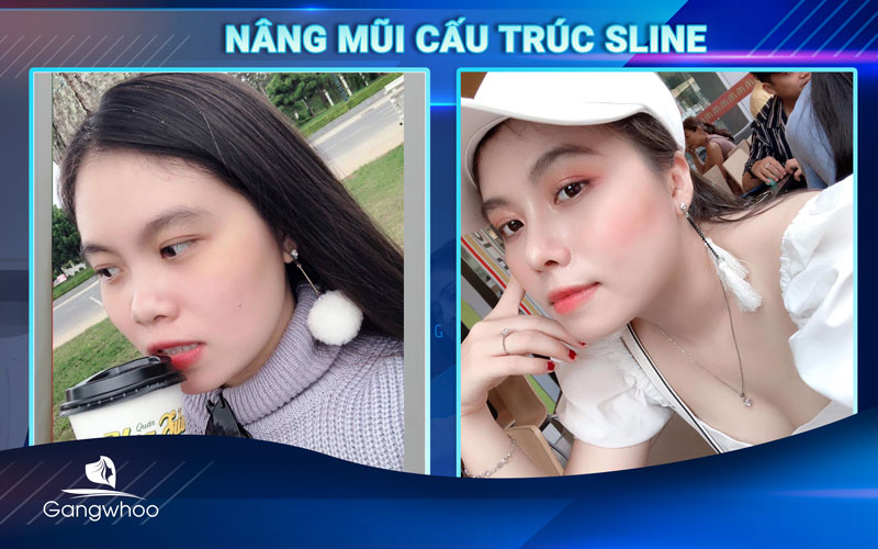 Gương mặt khách hàng "đặc biệt" hơn sau khi nâng mũi cấu trúc S-line
