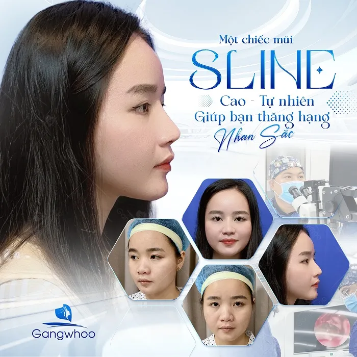 TMV Gangwhoo - Địa chỉ nâng mũi đẹp, an toàn