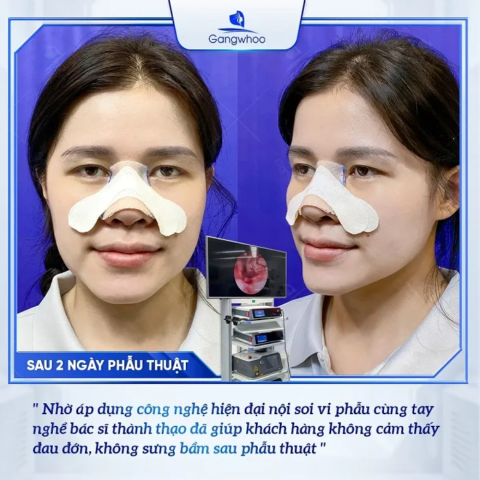 Nâng mũi an toàn, không sưng bầm sau nâng tại Gangwhoo
