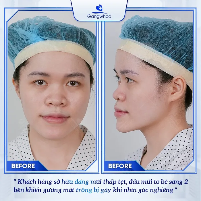 Trường hợp nên nâng mũi 