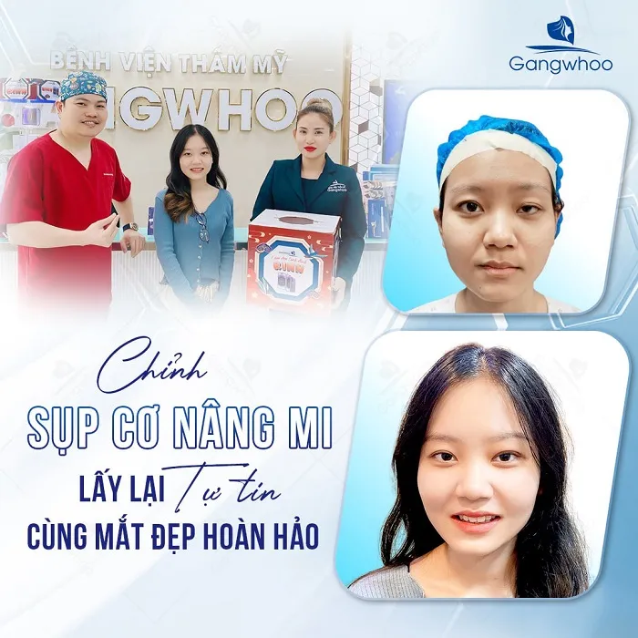 Chỉnh sụp mí tại Gangwhoo với đội ngũ bác sĩ giàu kinh nghiệm 