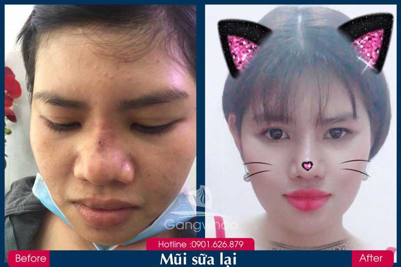 Kết quả khách hàng nâng mũi