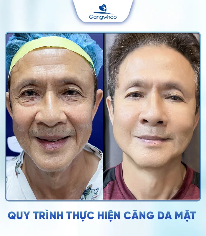 Căng Da Mặt Là Gì? Căng Da Mặt Uy Tín Và An Toàn Ở Đâu?