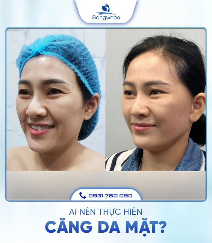 Căng Da Mặt Là Gì? Căng Da Mặt Uy Tín Và An Toàn Ở Đâu?