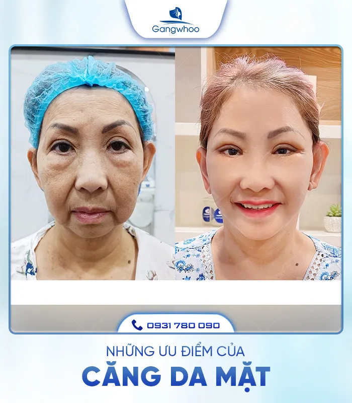 Căng Da Mặt Là Gì? Căng Da Mặt Uy Tín Và An Toàn Ở Đâu?