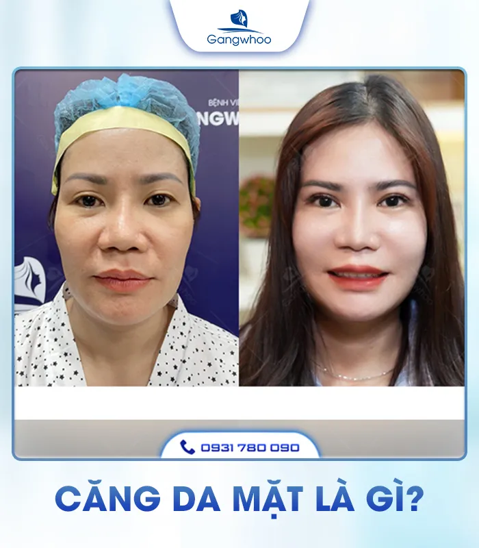 Căng Da Mặt Là Gì? Căng Da Mặt Uy Tín Và An Toàn Ở Đâu?