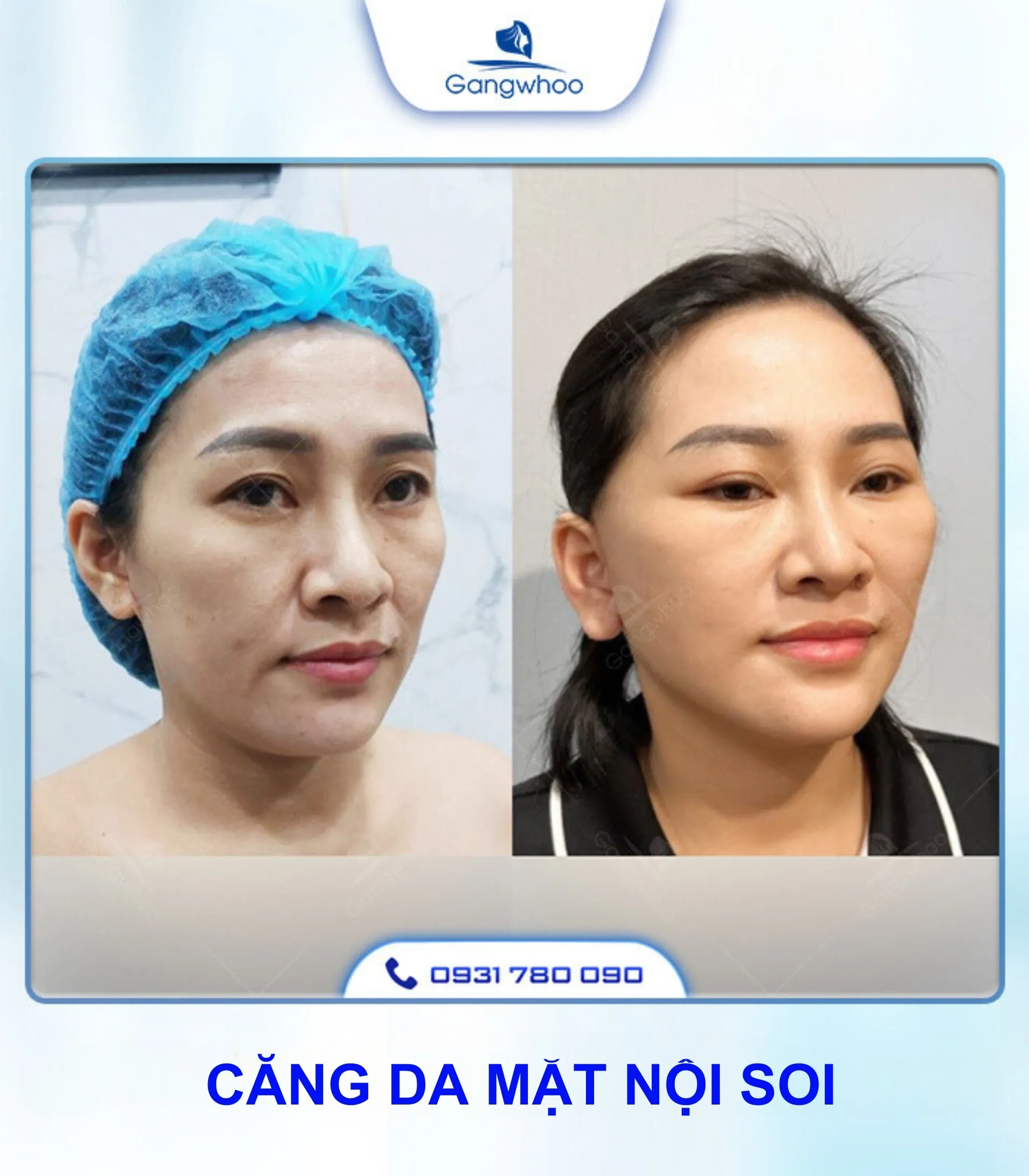 Căng Da Mặt Là Gì? Căng Da Mặt Uy Tín Và An Toàn Ở Đâu?