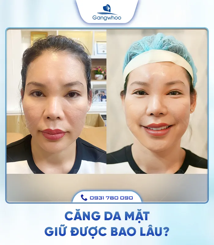 Căng Da Mặt Là Gì? Căng Da Mặt Uy Tín Và An Toàn Ở Đâu?