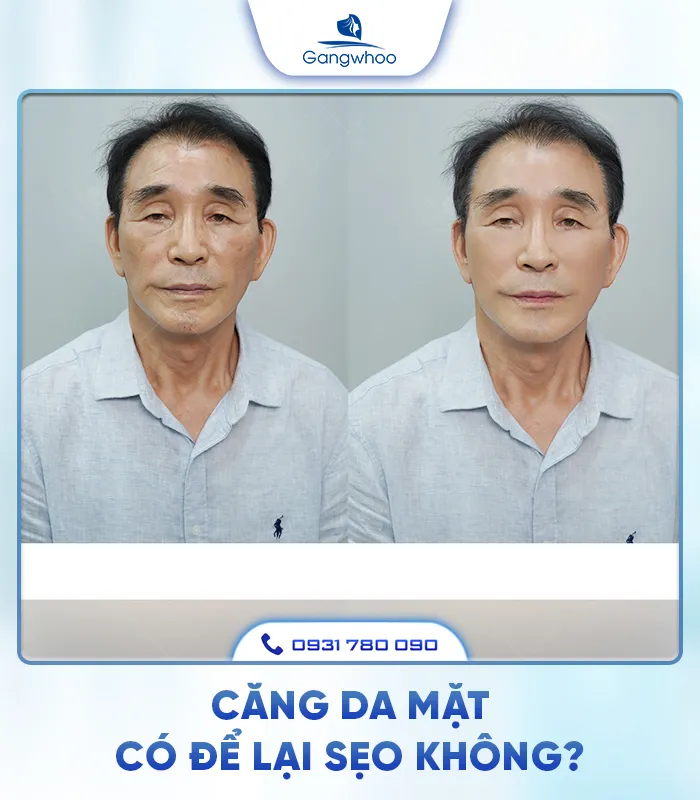 Căng Da Mặt Là Gì? Căng Da Mặt Uy Tín Và An Toàn Ở Đâu?