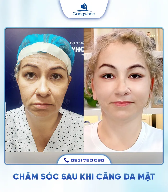 Căng Da Mặt Là Gì? Căng Da Mặt Uy Tín Và An Toàn Ở Đâu?