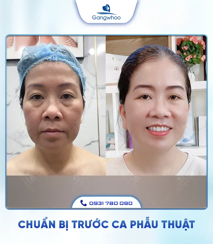 Căng Da Mặt Là Gì? Căng Da Mặt Uy Tín Và An Toàn Ở Đâu?