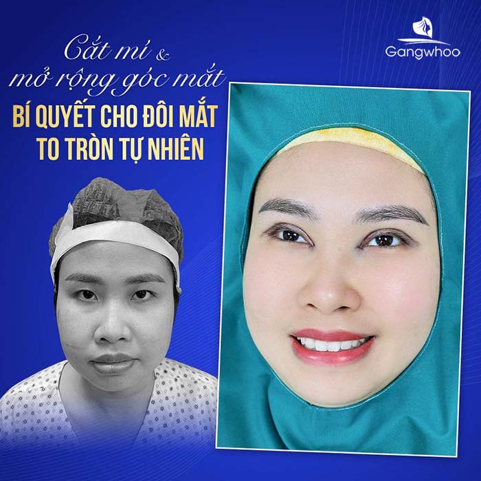 Mở Góc Mắt Trong Mini Giúp Mắt To Và Xinh Lung Linh