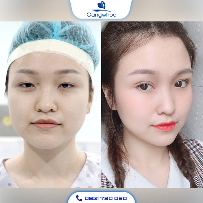 Tạo Hình Góc Mắt Trong Giúp Mắt Cân Xứng Đẹp Hoàn Mỹ